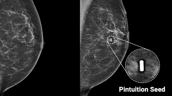 mammo orion mammography 2