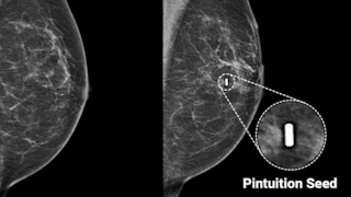 mammo orion mammography 2