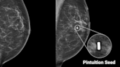 mammo orion mammography 2