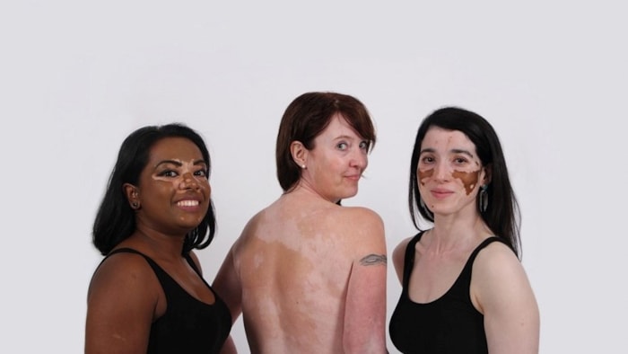 Vitiligo Foto Krista Simons