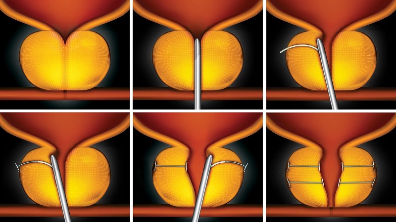 Bijna de helft van mannen van 50 jaar en ouder heeft plasproblemen